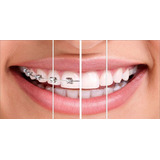 Quadro Decorativo Dentes Aparelho Odontológico  Para Clinica