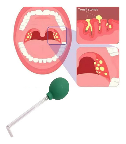 Herramienta De Extracción De Cálculos De Amígdalas Para Adul