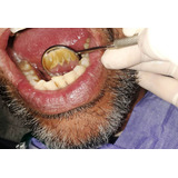 Limpieza Dental Ultrasónica Remoción De Tártaro