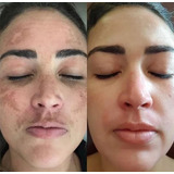 Tratamento Melasma/espinha: Ácido Retinoico40% 20ml + Tca35%