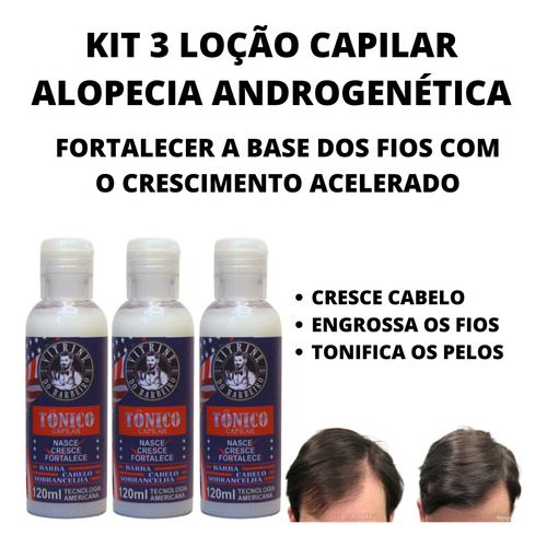 3 Loção Fortalece Cabelos Fracos Anti Alopecia Androgenética