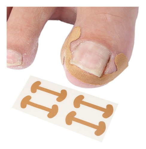 12 Piezas Corrector De Uñas Encarnadas,