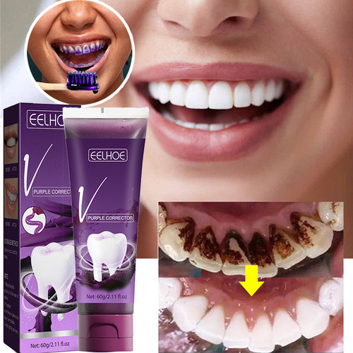 Branqueamento Dental Roxo Remoção De Manchas Dentais Branque