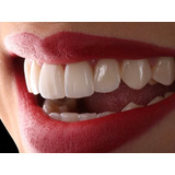Blanqueamiento Dental Led +limpieza Dental + Fluor