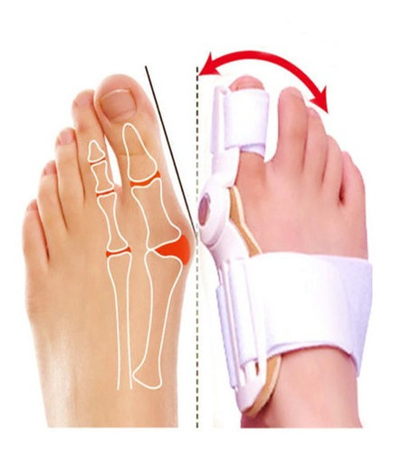 Corrector Juanetes Ortesis Hallux Valguso