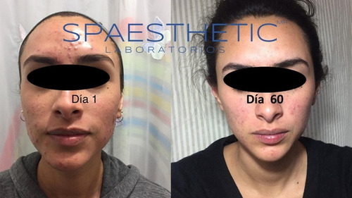 Tratamiento Antiacne