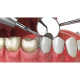 Limpieza Dental Con Ultrasonido 