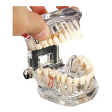 Modelo Dental - Enseñanza Implantes Puentes - Envío Gratis