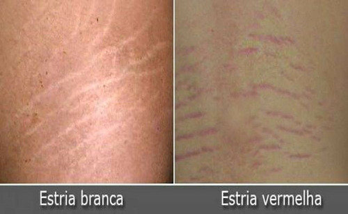 Anti Estrias Creme Clareador De Estrias 20ml + Tca