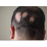 3 Shampo Natur Auxiliar Para Eliminar La Alopecia Areata 