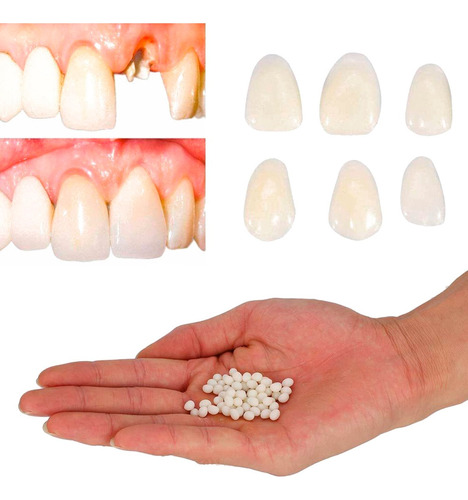 Dientes Postizos Provisorio Moldeable Facil Aplique Kit X5