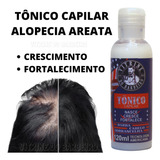 Tônico Capilar Cura Alopécia Androgenética Cura Calvicie