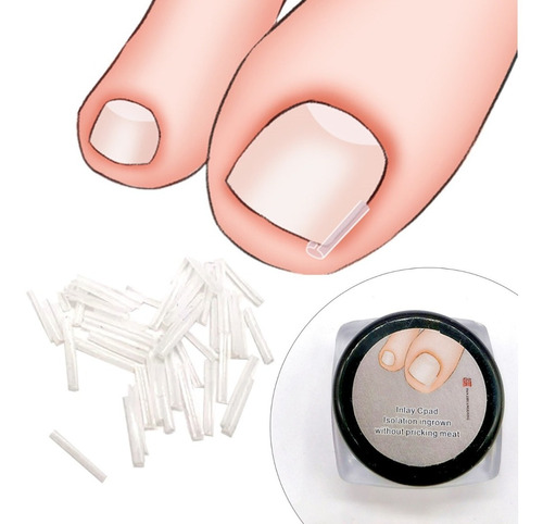 Corrector De Uñas Encarnadas 20 Pcs