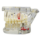 Manequim Macro Modelo Odontológico Implantes Próteses Dental