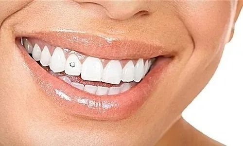 Piercing Dental Odontología 40 Unidades X Mayor