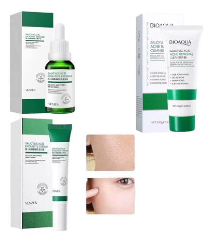 Kit Acido Salicílico Antiacne 