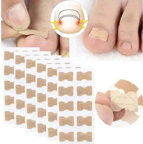 Parche Corrector De Uñas Encarnadas X 20 Unidades