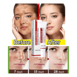 1creme Facial Clareador Melasma Acne Sardas Manchas Escuras 