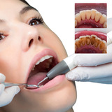 Limpieza Oral Con Ultrasonido Ambos Maxilares