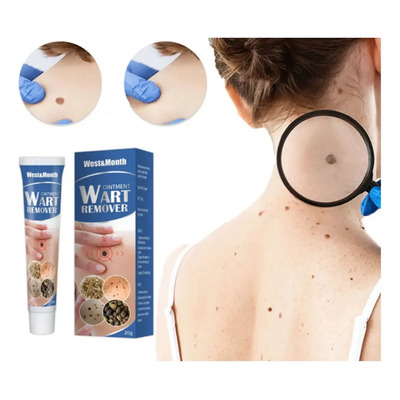 Crema For Eliminar El Acné A Base De Wart Remover