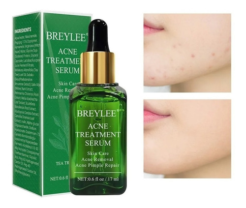 Serum Tratamiento Para Acne Pieles Grasas 100% Efectividad Tipo De Piel Grasa