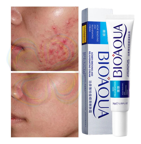 Crema Bioaqua Puntos Negros Anti Acne Cicatrices Poros 