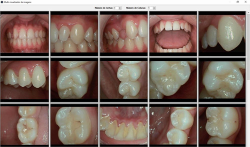 Câmera Intraoral Microimagem Iris