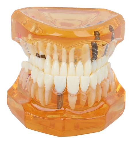 Estudo Removível De Doença Dentária Modelo De Dentes De Ensi