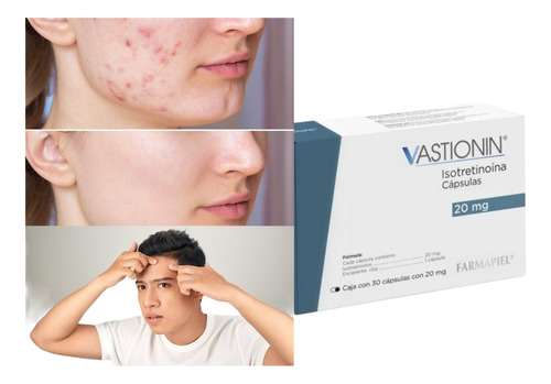 Elimador De Acne Espinillas Barros Comedones 