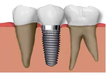 Implante Dental Straumann Con Corona De Porcelana. Belgrano