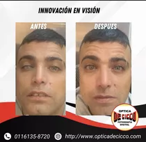 Prótesis Oculares Adaptación 50 Años Solucionando Vidas!!!