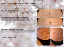 Flacidez Abdominal Plasma Pen Rico En Plaquetas Regeneración