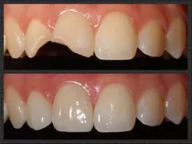 Carillas Dentales Composite Porcelana Belgrano (sin Envio)