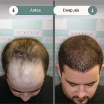 Trasplante De Cabello