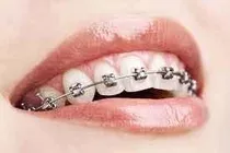 Colocacion Brackets Ortodoncia Tratamiento