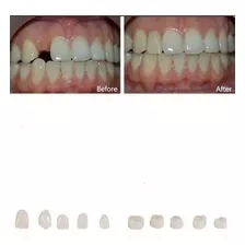 16 Coroas Facetas Dentes Frente + Massa Fixadora Reparo