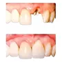Terceira imagem para pesquisa de dente provisorio