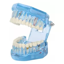 Implante Dental Manequim Modelo Odonto Boca Inteira.