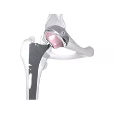 Prótesis De Cadera, Bipolar Cementada, Traumatología