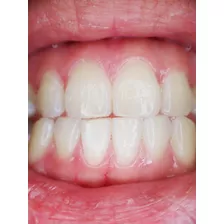 Resina Dental
