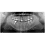 Tercera imagen para búsqueda de radiografia panoramica dental precio