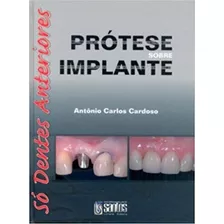 Prótese Sobre Implante -só Dentes Anteriores #0463#