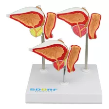 Modelo Patológico Da Próstata Em 3 Fases