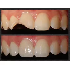 Carillas Dentales Composite Porcelana Belgrano (sin Envio)