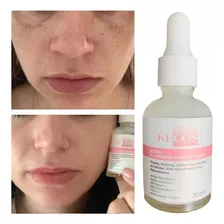 Clareador De Manchas Faciais, Melasma, Sardas, Espinhas, Sol