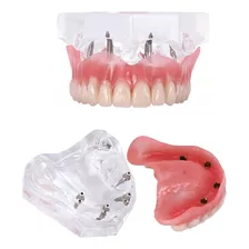 Modelo Superior Implantes Dentários Protocolo Overdenture 