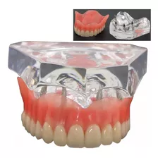 Modelo Superior Protocolo Implante Dentes Manequim Dentista 