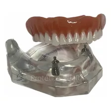 Manequim Modelo Odontológico Overdenture O-ring P/ Dentistas