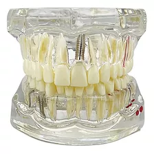 Macro Modelo Odontológico Anatômico Implantes Endo E Sisos