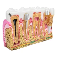 Modelo Dental Didáctico Modelo De Caries Dental Modelo Denta